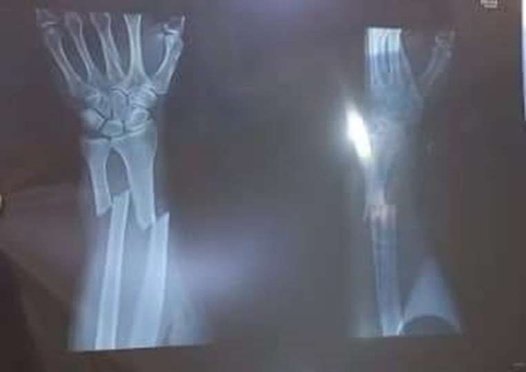 Hilber Mejía terminó con una fractura en el brazo izquierdo/ Foto: Huber Vaca