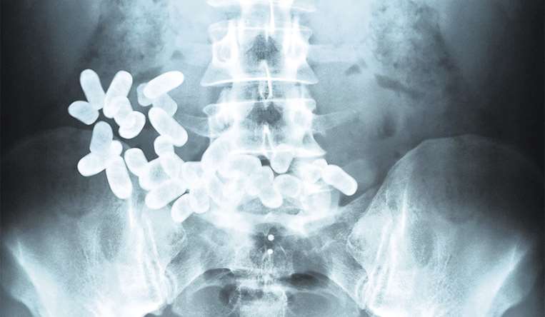 Una radiografía del vientre de una persona que transportaba droga